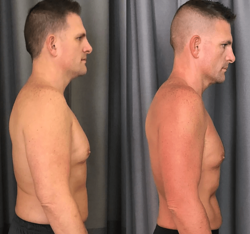 Testosterone Therapy Before and After Photos